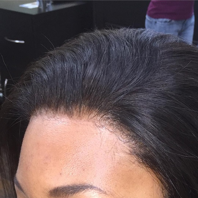 Closure brings a natural looking scalp